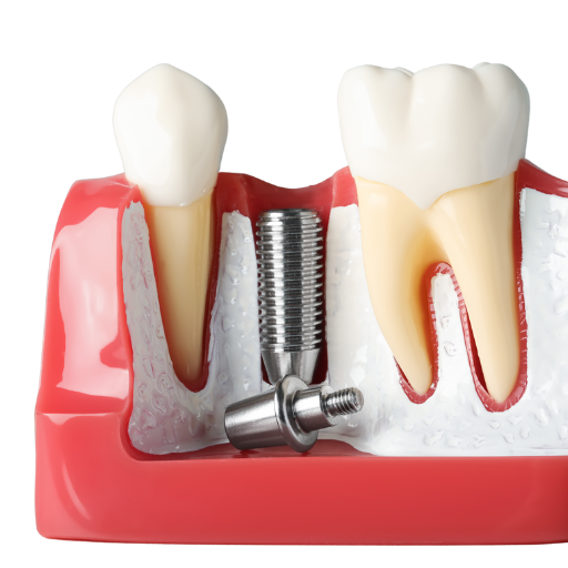 Implante Dentário